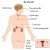 Bệnh nội tiết ở phụ nữ nguyên nhân vô sinh hiếm muộn