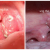 Phân biệt viêm họng thông thường và ung thư vòm họng