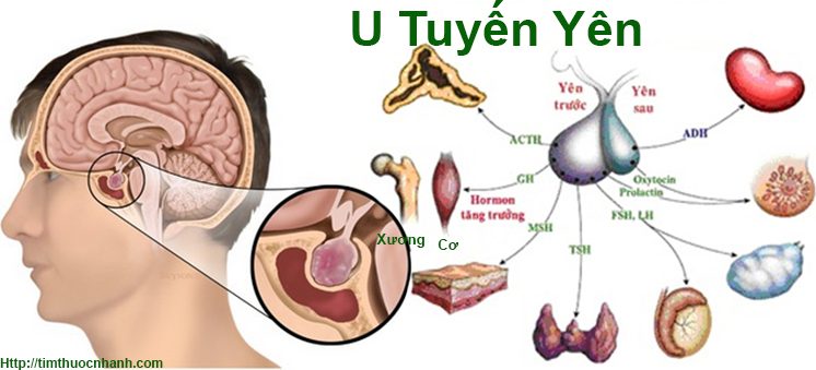 Khối u tuyến yên - Ảnh minh họa 3