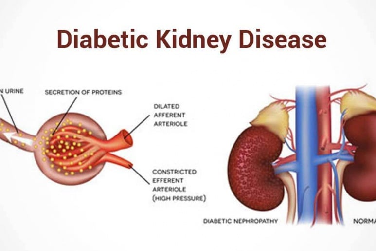 Kidney Failture - Ảnh minh họa 2