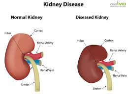 Kidney Failture - Ảnh minh họa 3