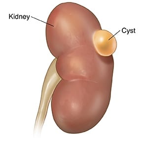 Kidney cyst - Ảnh minh họa 2