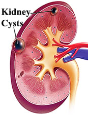 Kidney cyst - Ảnh minh họa 3