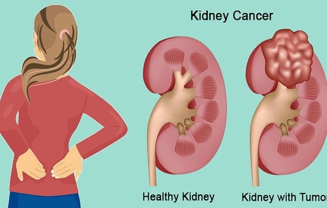 Kidney cancer - Ảnh minh họa 2