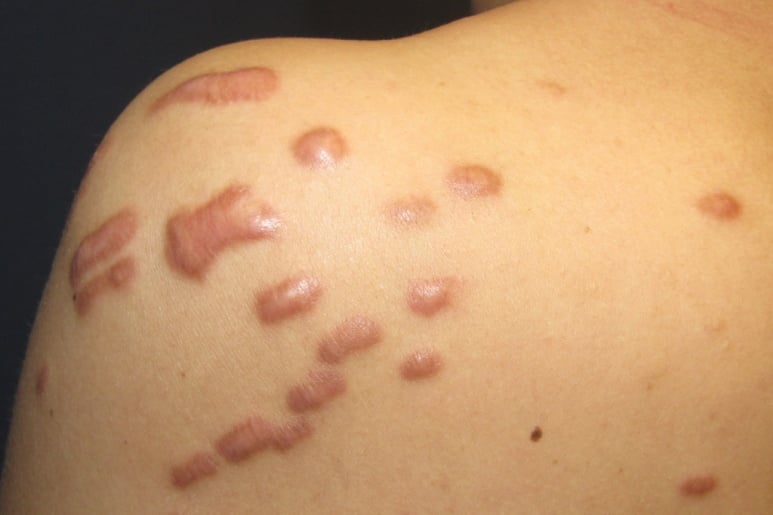 Keloid - Chéloïde - Ảnh minh họa 1