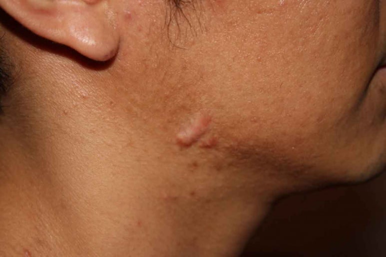 Keloid - Chéloïde - Ảnh minh họa 4