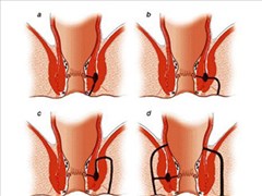 Khe nứt và lỗ rò hậu môn, trực tràng - Ảnh minh họa 5