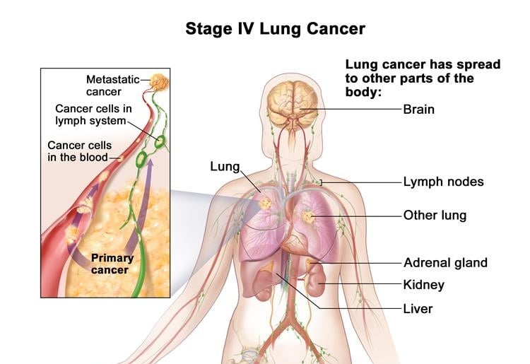 Kidney cancer - Ảnh minh họa 3