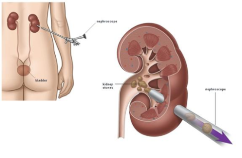 Kidney stone - Ảnh minh họa 5