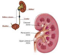 Kidney stone - Ảnh minh họa 4