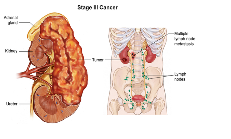 Kidney cancer - Ảnh minh họa 4