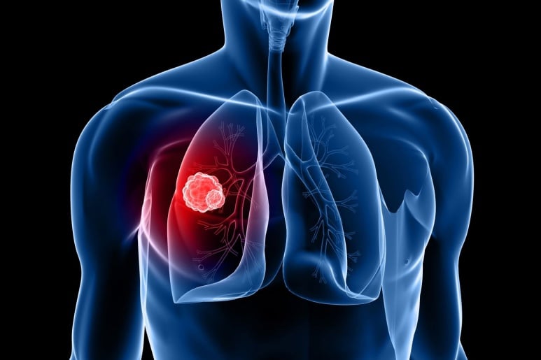 Lung cancer - Ảnh minh họa 1