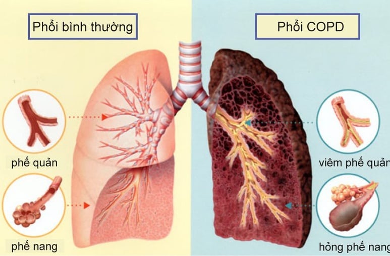 Lao phổi - Ảnh minh họa 1