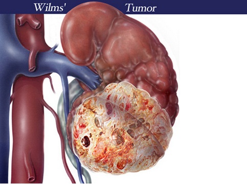 Khối u Wilms - Ảnh minh họa 1