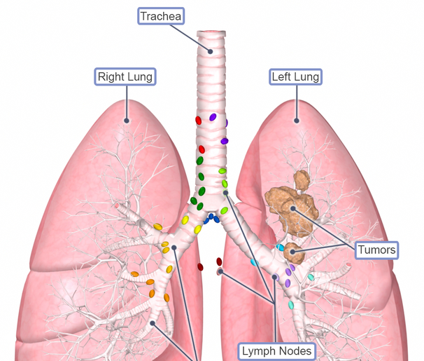 Lung cancer - Ảnh minh họa 4