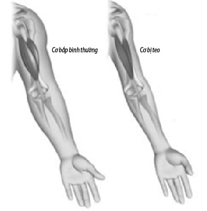 Loạn dưỡng cơ - Ảnh minh họa 5