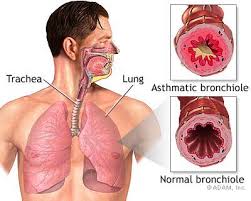 Asthma - Ảnh minh họa 2