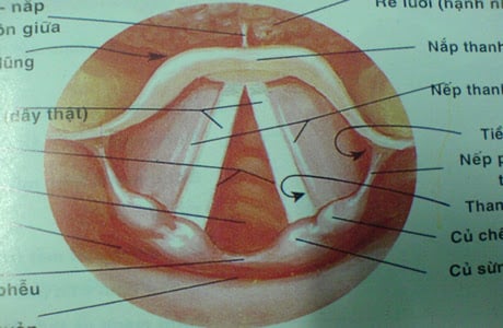Liệt dây thanh - Ảnh minh họa 2