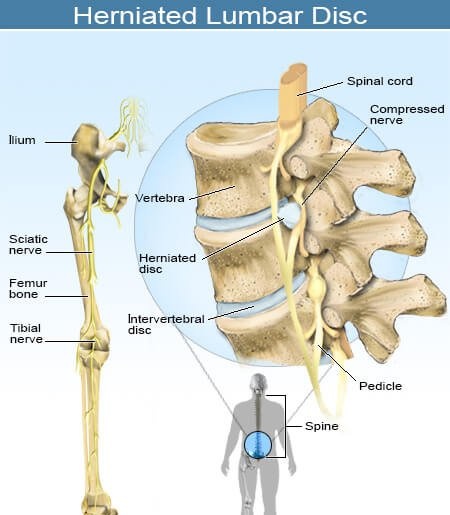Low back pain - Ảnh minh họa 3