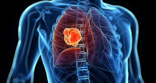 Lung cancer - Ảnh minh họa 5