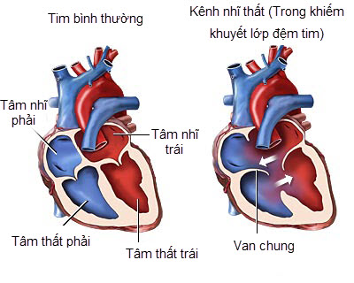 Khiếm khuyết vách liên nhĩ - Ảnh minh họa 3