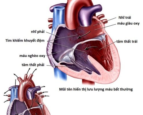 Khiếm khuyết vách liên nhĩ - Ảnh minh họa 4