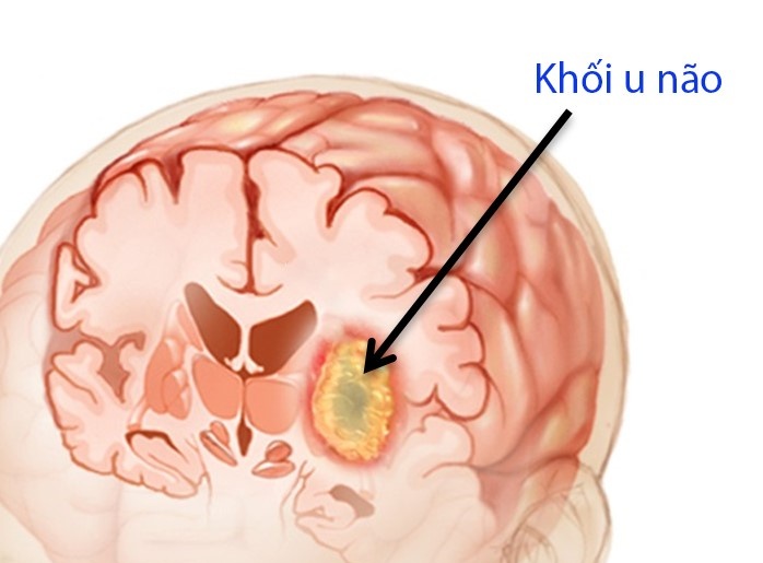 Khối u di căn - Ảnh minh họa 4