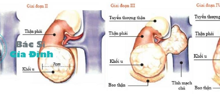 Khối u Wilms - Ảnh minh họa 2