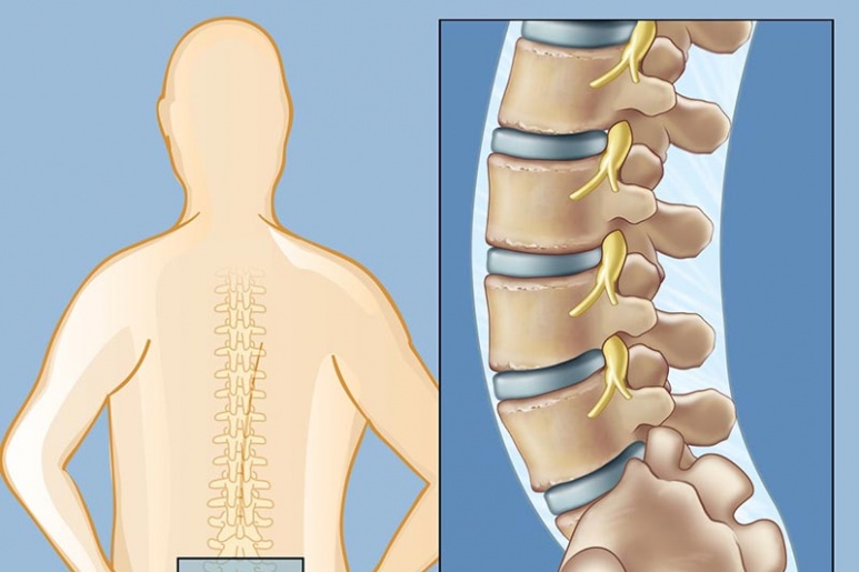 Low back pain - Ảnh minh họa 4
