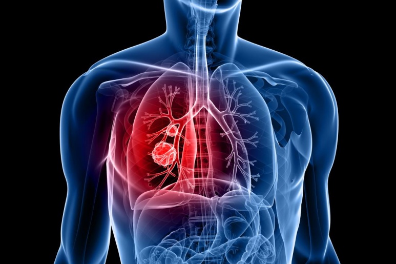 Lung cancer - Ảnh minh họa 2