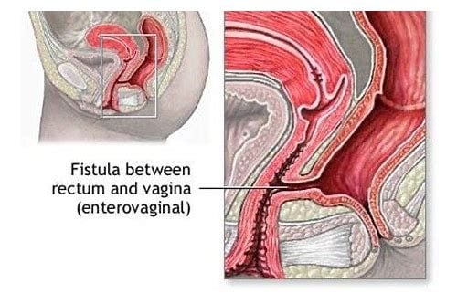 Lỗ rò trực tràng – âm đạo - Ảnh minh họa 4