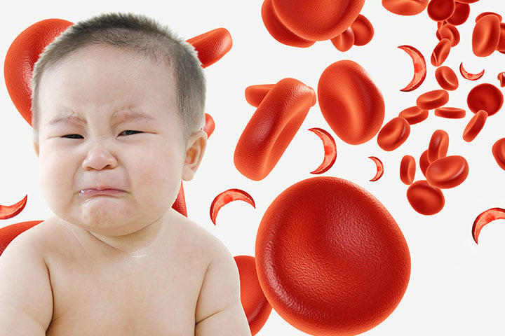 Anaemia - Ảnh minh họa 4