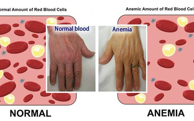 Anaemia - Ảnh minh họa 3