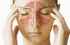 Acute sinusitis - Ảnh minh họa 2