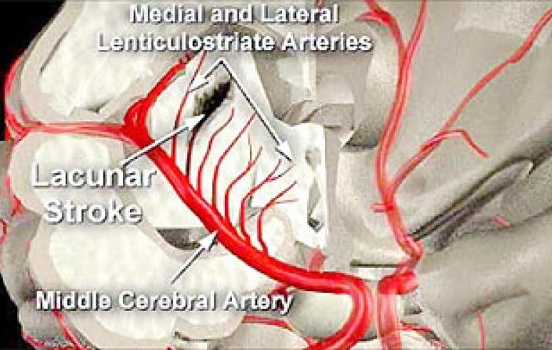 lacunar-infarction - Ảnh minh họa 2