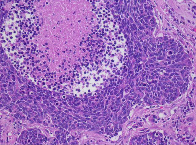 Large cell carcinoma - Ảnh minh họa 1