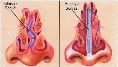 Lệch vách ngăn mũi - Ảnh minh họa 1