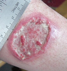 Leishmaniasis - Ảnh minh họa 1