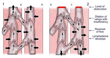 Lymphatic obstruction - Ảnh minh họa 1