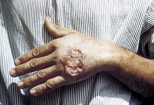 Leishmaniasis - Ảnh minh họa 2