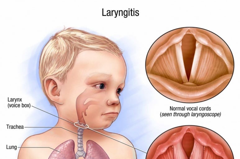 Laryngitis - Ảnh minh họa 1