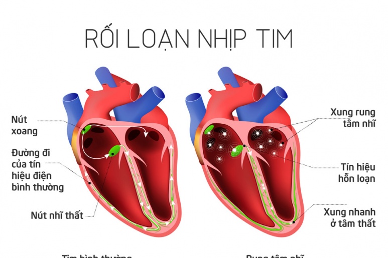 Loạn nhịp tim - Ảnh minh họa 1