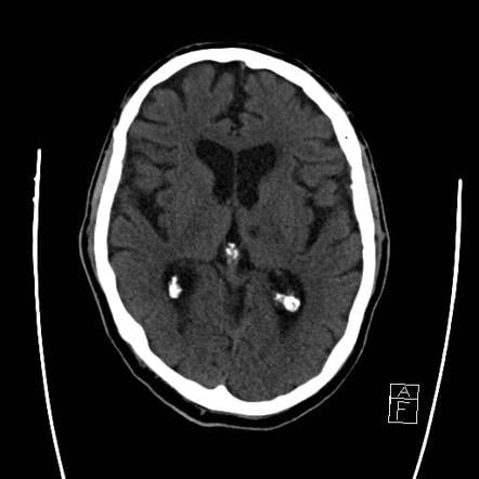 lacunar-infarction - Ảnh minh họa 1