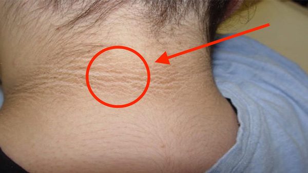 Acanthosis Nigricans - Ảnh minh họa 1