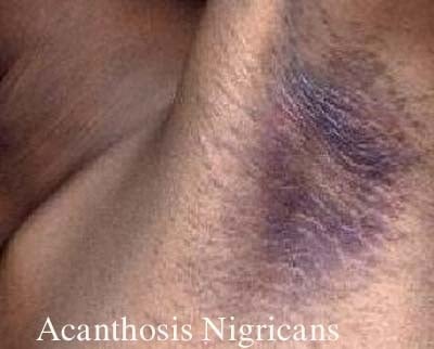 Acanthosis Nigricans - Ảnh minh họa 2