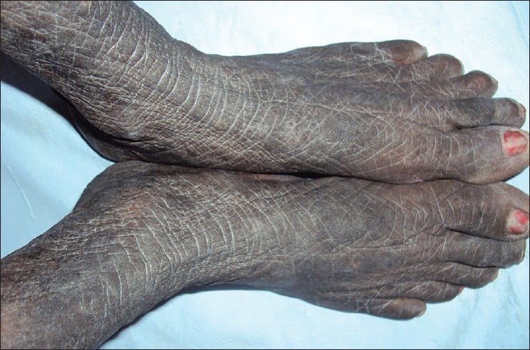 Acanthosis Nigricans - Ảnh minh họa 3