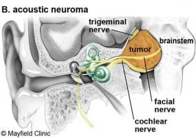 Acoustic Schwannoma - Ảnh minh họa 4