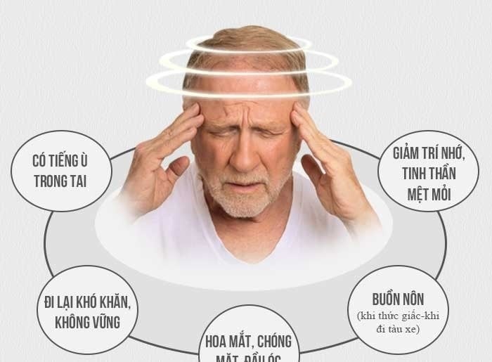 Acoustic Schwannoma - Ảnh minh họa 2