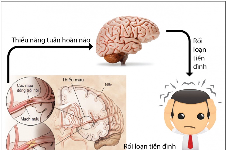 Acoustic Schwannoma - Ảnh minh họa 3