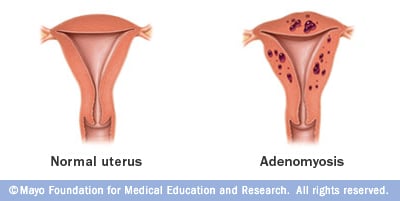 Adenomyosis - Ảnh minh họa 3